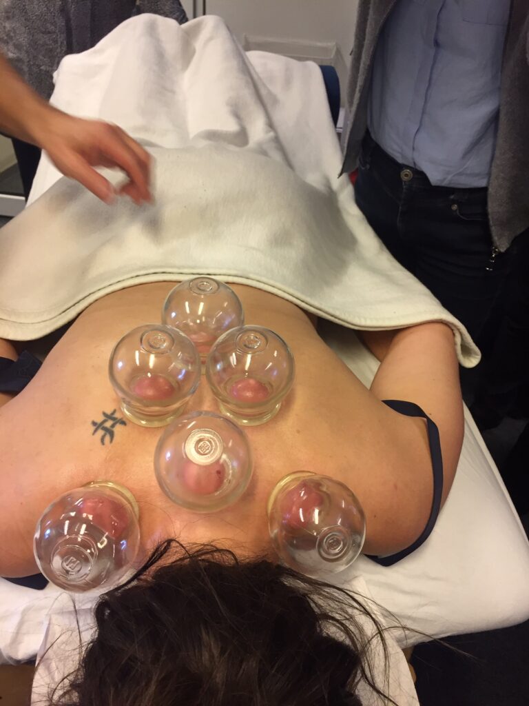 cupping behandling hos helbreds klinikken